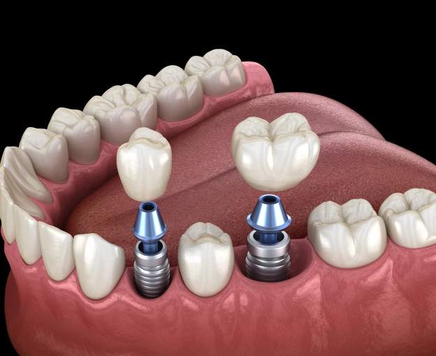 Dental Implants Cincinnati, OH