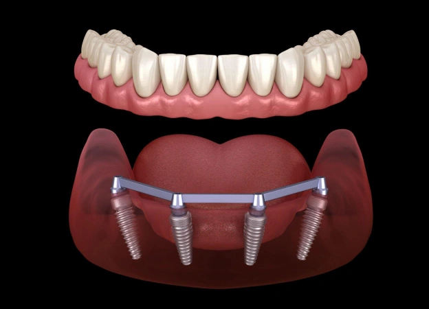 Dental implant prosthetic showing artificial teeth attached to gum model with four implant posts.
