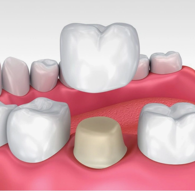 3D dental crown illustration showing tooth replacement procedure with natural teeth and gum tissue model.
