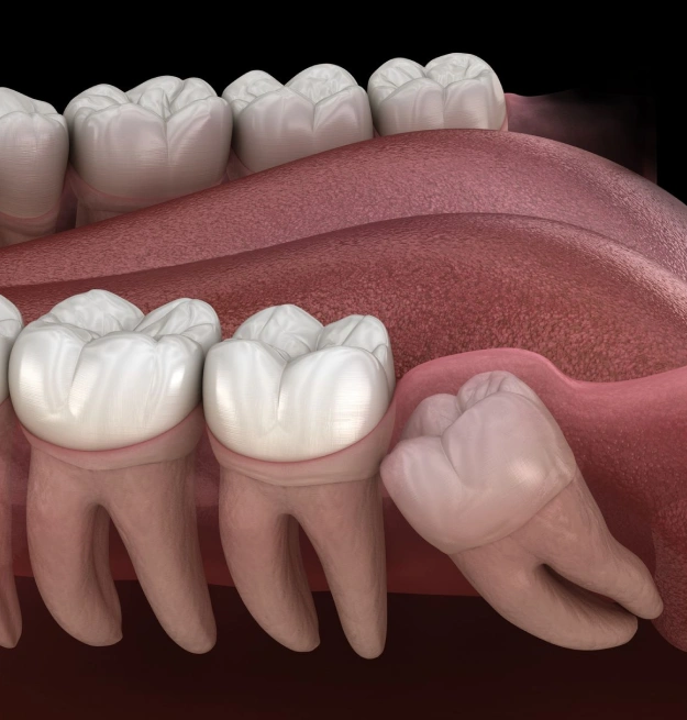 Dental illustration showing wisdom tooth extraction with surrounding teeth and gum anatomy in cross-section.