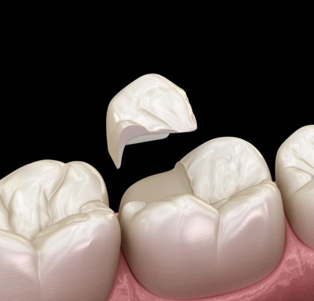 Animated tooth with white crown restoration and pink gum tissue against black background.