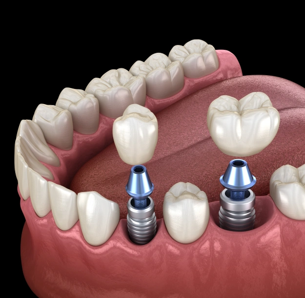 Dental Implants in Cincinnati, OH