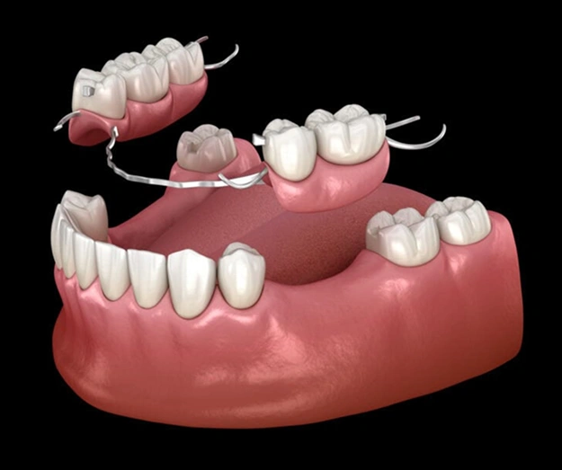 3D dental implant model showing multiple tooth replacements on pink gum structure.