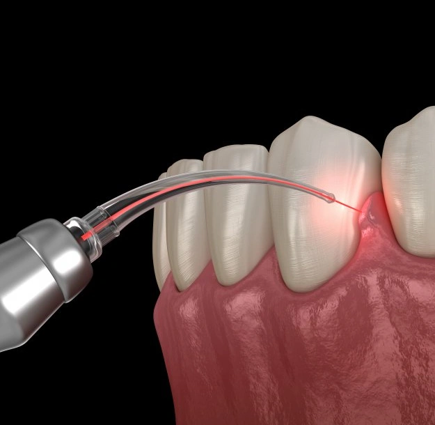 Laser gum treatment device performing periodontal therapy on inflamed gum tissue around teeth.