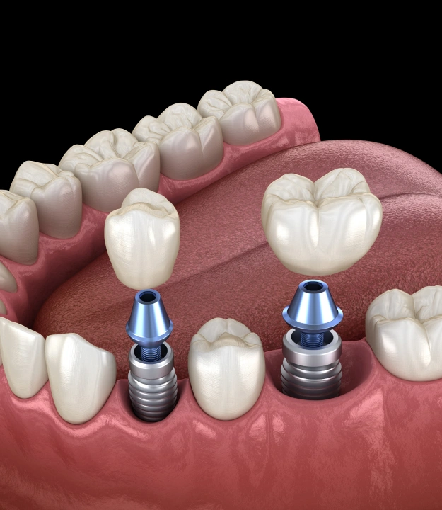 Dental Implants in Cincinnati, OH